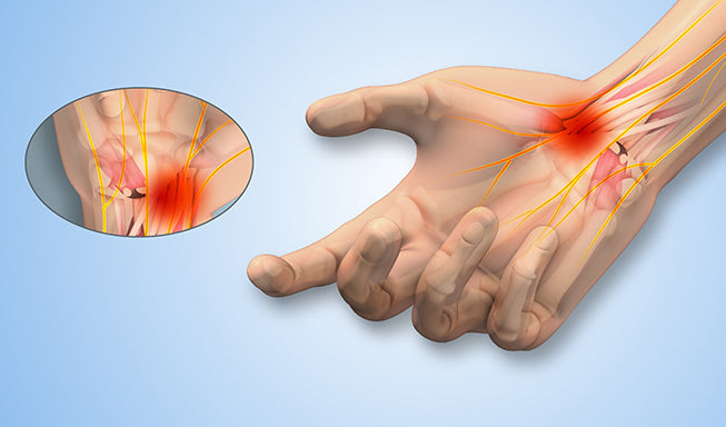 Carpal Tunnel Syndrome