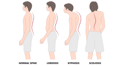 4 person with kyphosis symptoms