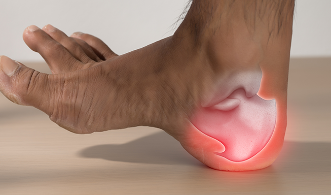 Plantar Fasciitis Pain