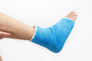 person showing his fractured ankle with plaster