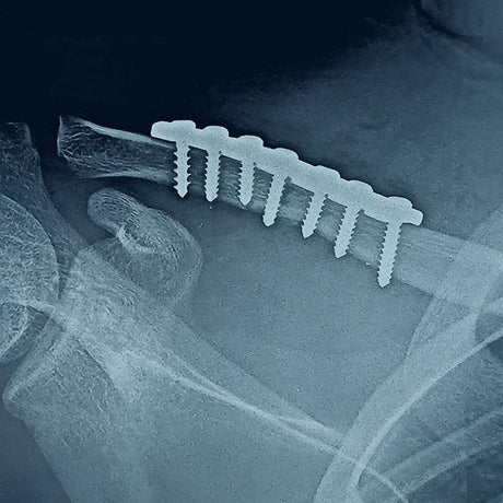 Recovery from fracture or dislocation