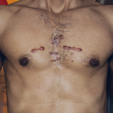 Post-Thoracic Surgery Patients