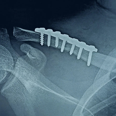 Arm or Shoulder Fractures